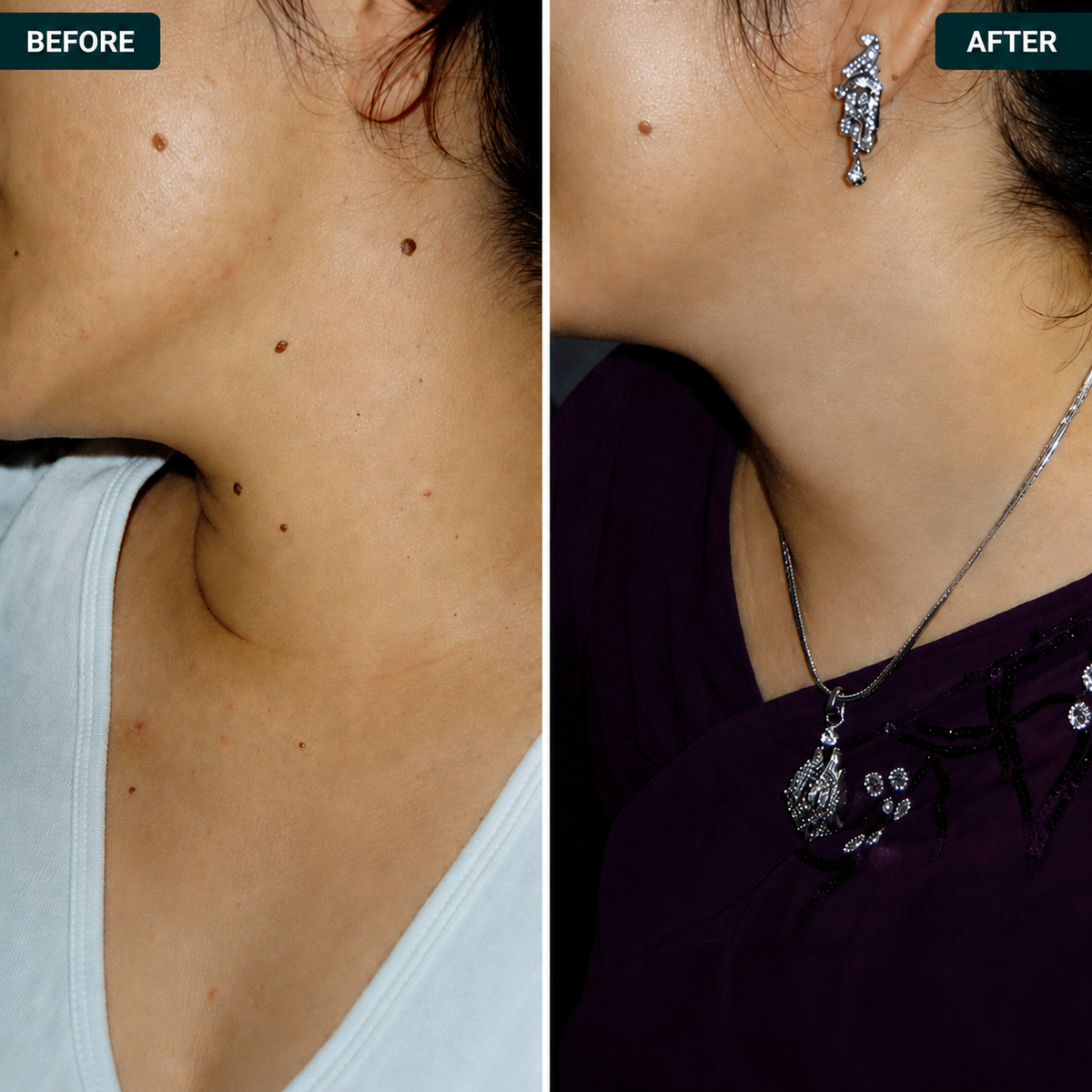 Dermora™ Skin Tag Removal