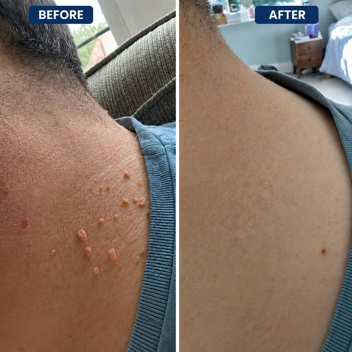 Dermora™ Skin Tag Removal