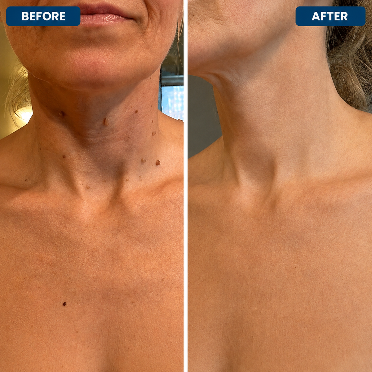 Dermora™ Skin Tag Removal