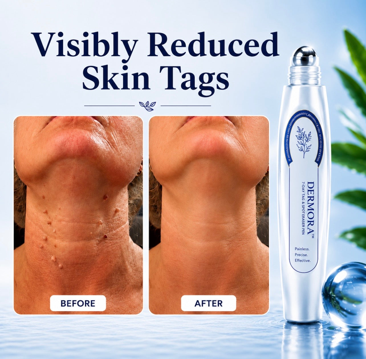 Dermora™ Skin Tag Removal